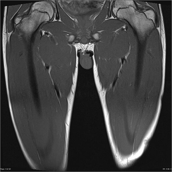 File:Normal muscles (Radiopaedia 24221-24491 Coronal T1 4).jpg