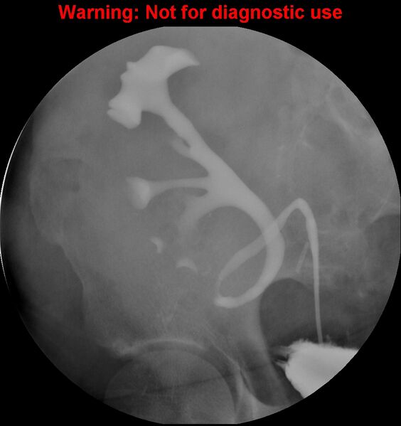 File:Normal retrograde pyelography of a native and transplant kidney (Radiopaedia 40480-43054 Transplant kidney 26).jpg