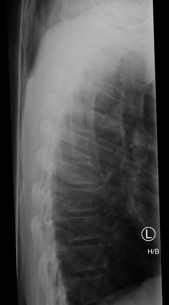 File:Normal trauma spine imaging (age 16) (Radiopaedia 45335-49357 Lateral 1).jpg