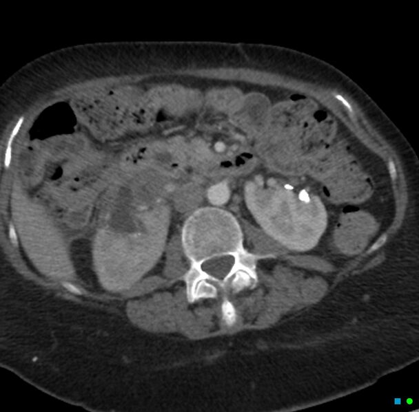 File:Obstructed infected horseshoe kidney (Radiopaedia 18116-17898 B 11).jpg