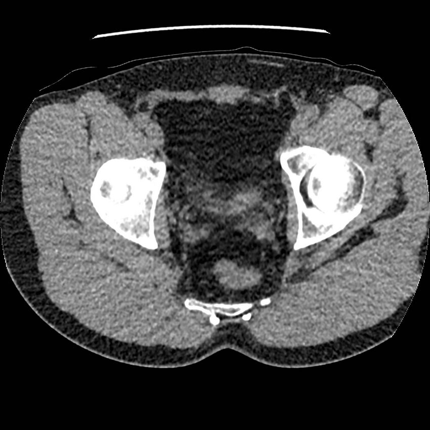 Obstructing ureteric calculus and ureteric anatomy (Radiopaedia 62730-71042 Axial non-contrast 156).jpg