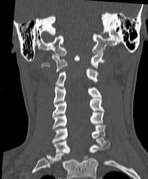 File:Occipital condyle fracture (Radiopaedia 61165-69056 Coronal bone window 6).jpg