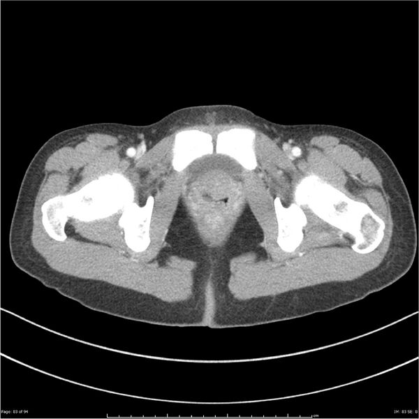 File:Traumatic renal artery dissection and pancreatic transection (Radiopaedia 37061-38739 Axial 276).jpg
