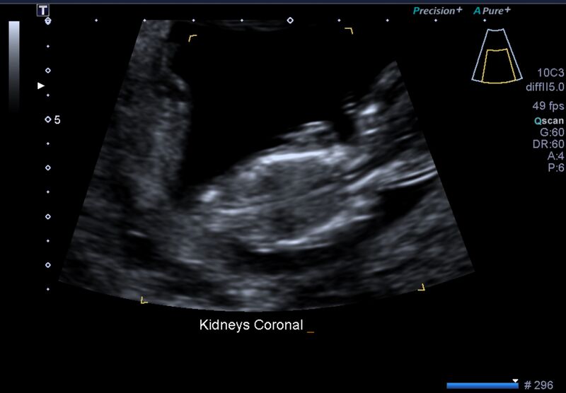 File:1st trimester nuchal-morphology ultrasound (Radiopaedia 44706-48477 General anatomy and NT 46).jpg