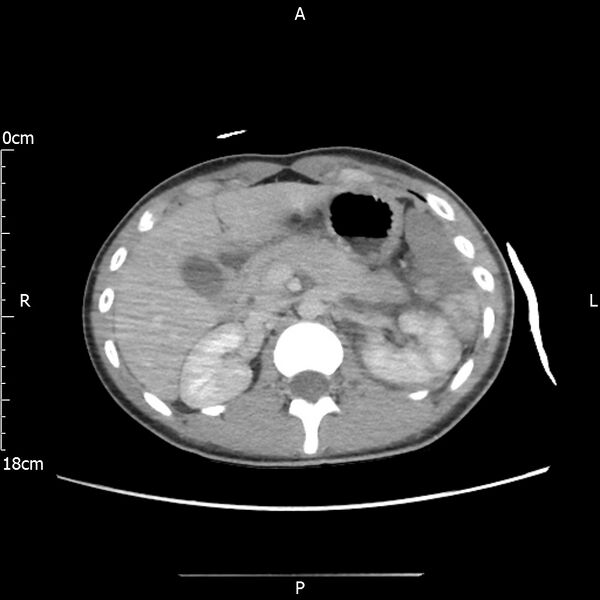 File:AAST grade IV kidney injury with CEUS follow-up (Radiopaedia 72353-82877 Axial C+ portal venous phase 22).jpg