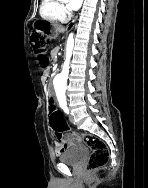 File:Abdominal aortic aneurysm (Radiopaedia 83581-98689 Sagittal C+ arterial phase 47).jpg