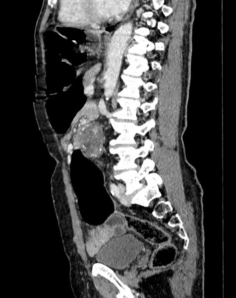 File:Abdominal aortic aneurysm (Radiopaedia 83581-98689 Sagittal C+ portal venous phase 65).jpg