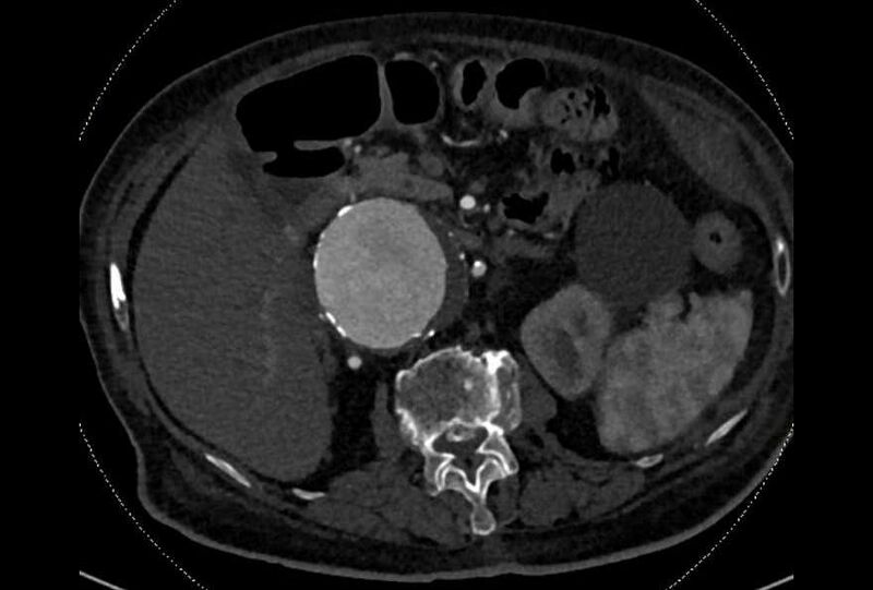 File:Abdominal aortic aneurysm with thrombus fissuration (Radiopaedia 73192-83919 Axial C+ arterial phase 52).jpg