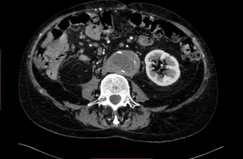 File:Abdominal aortic interposition tube graft and aneurysm thrombosis (Radiopaedia 71438-81857 Axial C+ arterial phase 94).jpg
