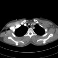 Abdominal multi-trauma - devascularised kidney and liver, spleen and pancreatic lacerations (Radiopaedia 34984-36486 Axial C+ arterial phase 18).png
