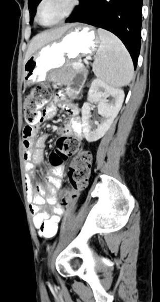 File:Abdominal wall and retroperitoneal tuberculosis (Radiopaedia 88137-104729 Sagittal C+ portal venous phase 48).jpg