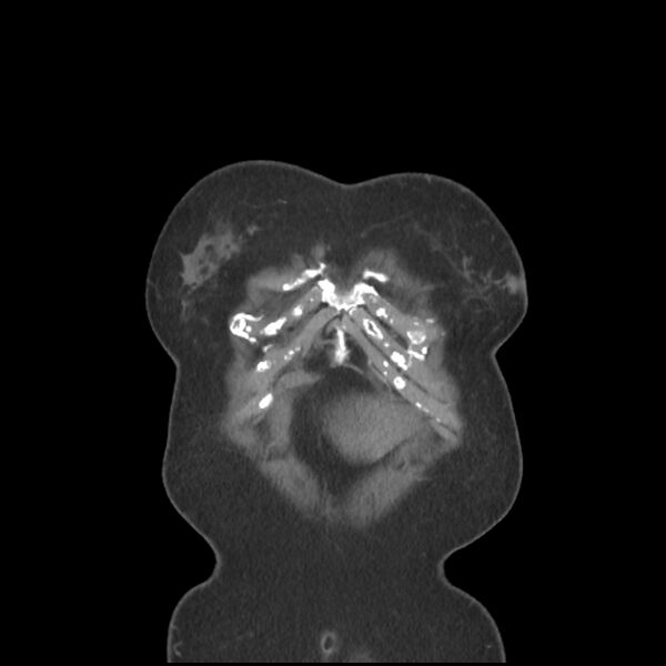 File:Aberrant right subclavian and left vertebral arteries (Radiopaedia 43467-46847 Coronal C+ portal venous phase 5).jpg
