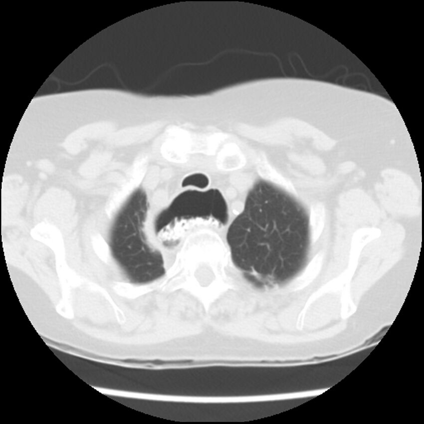 Achalasia (Radiopaedia 44094-47649 Axial lung window 7).jpg