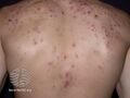 Acne affecting the back images (DermNet NZ acne-acne-back-165).jpg
