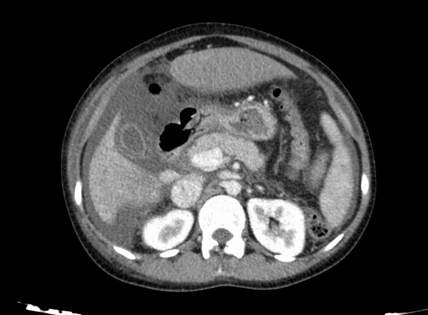 Acute Budd-Chiari syndrome (Radiopaedia 60858-68638 Axial C+ portal venous phase 111).jpg