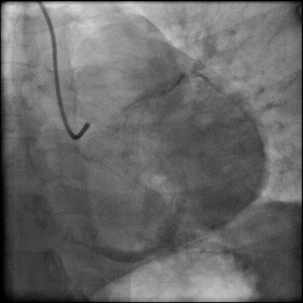 File:Acute anteroseptal myocardial infarction (Radiopaedia 68409-77946 LAO caudal (spider view) LAD and CX 80).jpg