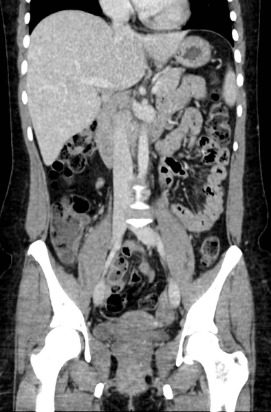 File:Acute appendicitis (Radiopaedia 22892-22918 Coronal C+ portal venous phase 25).png