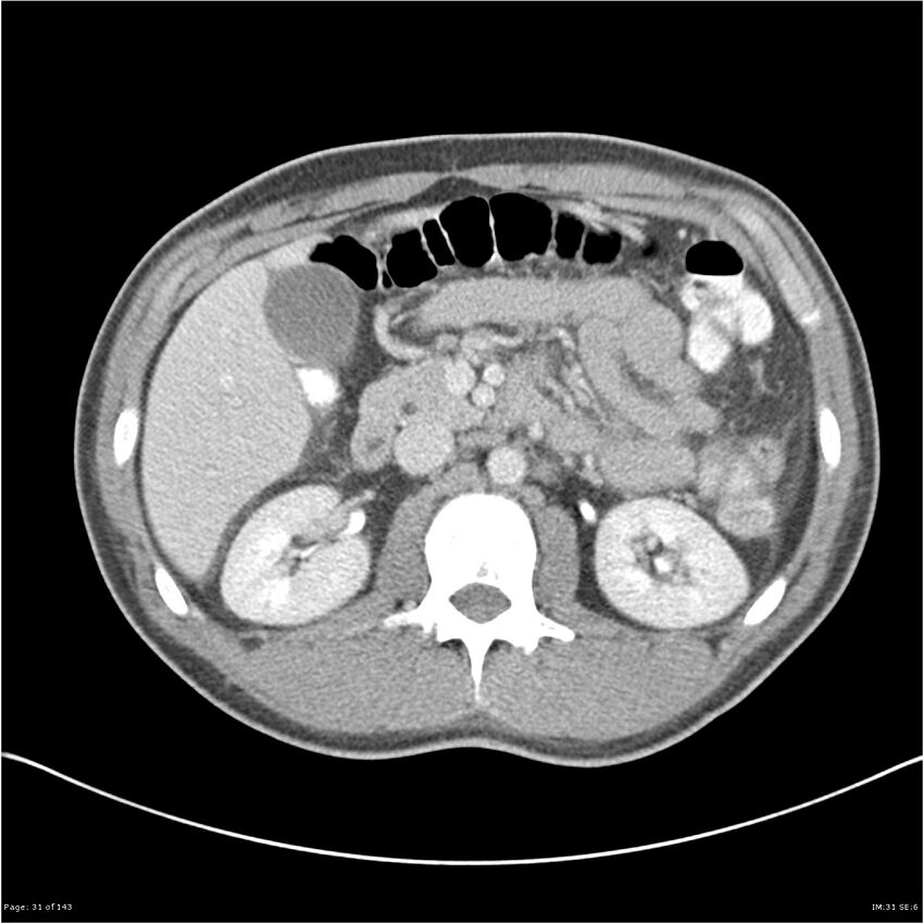 Acute appendicitis (Radiopaedia 25364-25615 B 21).jpg