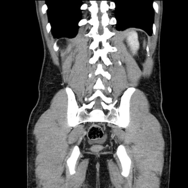 File:Acute appendicitis (Radiopaedia 27049-27227 Coronal C+ portal venous phase 46).jpg