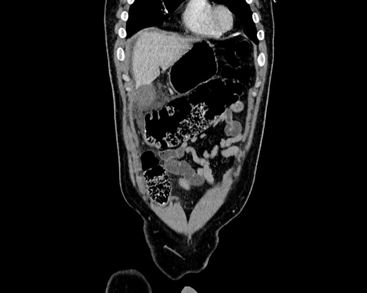 File:Acute cholecystitis (Radiopaedia 53216-59182 Coronal C+ portal venous phase 3).jpg