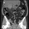 Acute cholecystitis and ureteric colic (Radiopaedia 42330-45444 Coronal prone 45).jpg