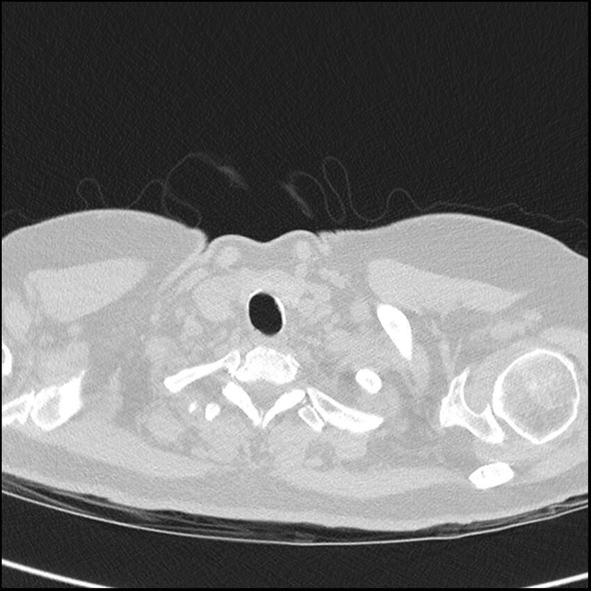 Acute interstitial pneumonitis (Radiopaedia 45404-49453 Axial lung window 3).jpg
