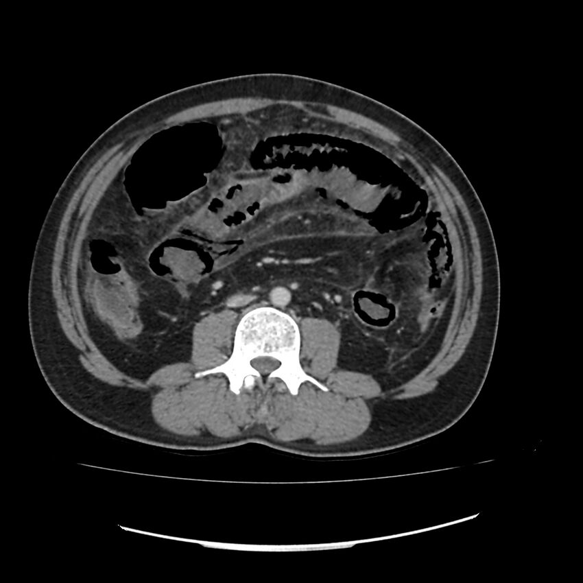 Acute mesenteric ischemia - superior mesenteric artery thrombosis (Radiopaedia 73947-84776 Axial C+ portal venous phase 76).jpg