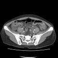 Acute myocarditis (Radiopaedia 55988-62613 Axial C+ portal venous phase 57).jpg