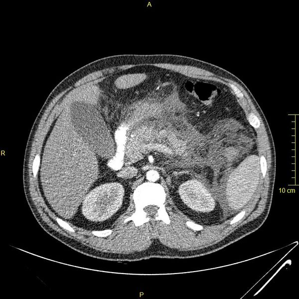 File:Acute pancreatitis (Radiopaedia 23231-23290 Axial C+ arterial phase 44).JPG