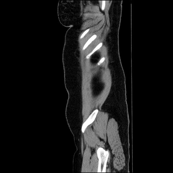 File:Acute pancreatitis (Radiopaedia 69236-79012 Sagittal C+ portal venous phase 19).jpg