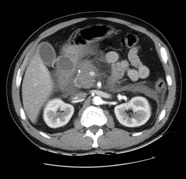 File:Acute pancreatitis - Balthazar E (Radiopaedia 23080-23110 Axial C+ arterial phase 25).jpg