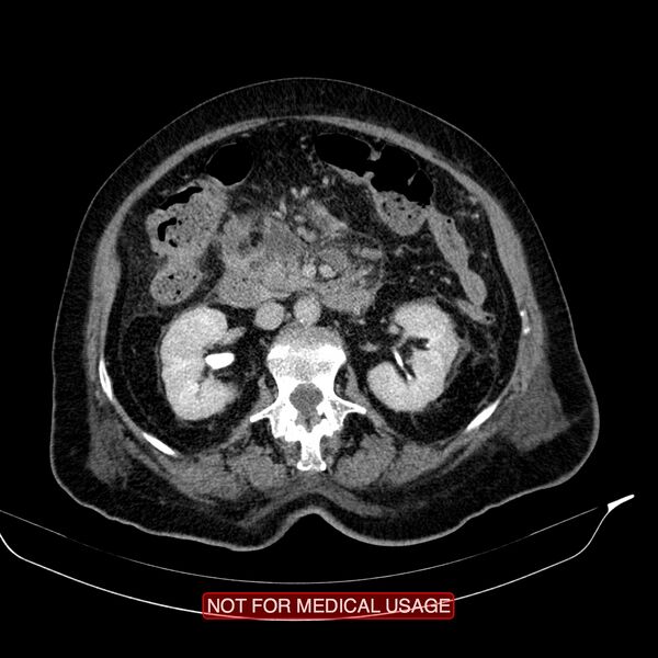 File:Acute pancreatitis with infected necrosis (Radiopaedia 26454-26585 Axial C+ delayed 17).jpg
