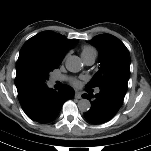 File:Acute pulmonary embolism (Radiopaedia 81677-95570 Axial non-contrast 10).jpg