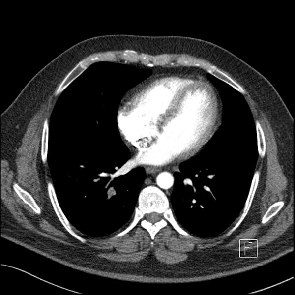 File:Acute pulmonary embolism with pulmonary infarct (Radiopaedia 73062-83768 Axial C+ CTPA 49).jpg