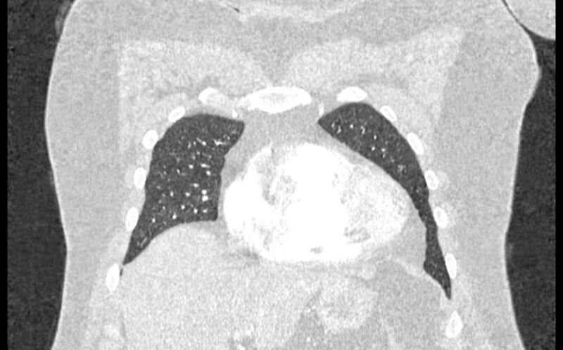 File:Acute pulmonary embolism with pulmonary infarcts (Radiopaedia 77688-89908 Coronal lung window 10).jpg