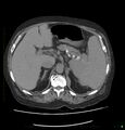 Acute renal failure post IV contrast injection- CT findings (Radiopaedia 47815-52559 Axial C+ portal venous phase 22).jpg