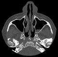 Acute sinusitis (Radiopaedia 23161-23215 Axial bone window 23).jpg