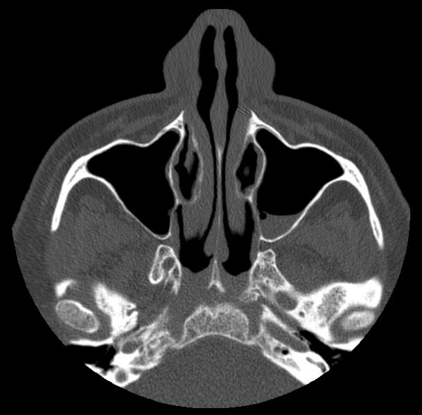 File:Acute sinusitis (Radiopaedia 23161-23215 Axial bone window 23).jpg