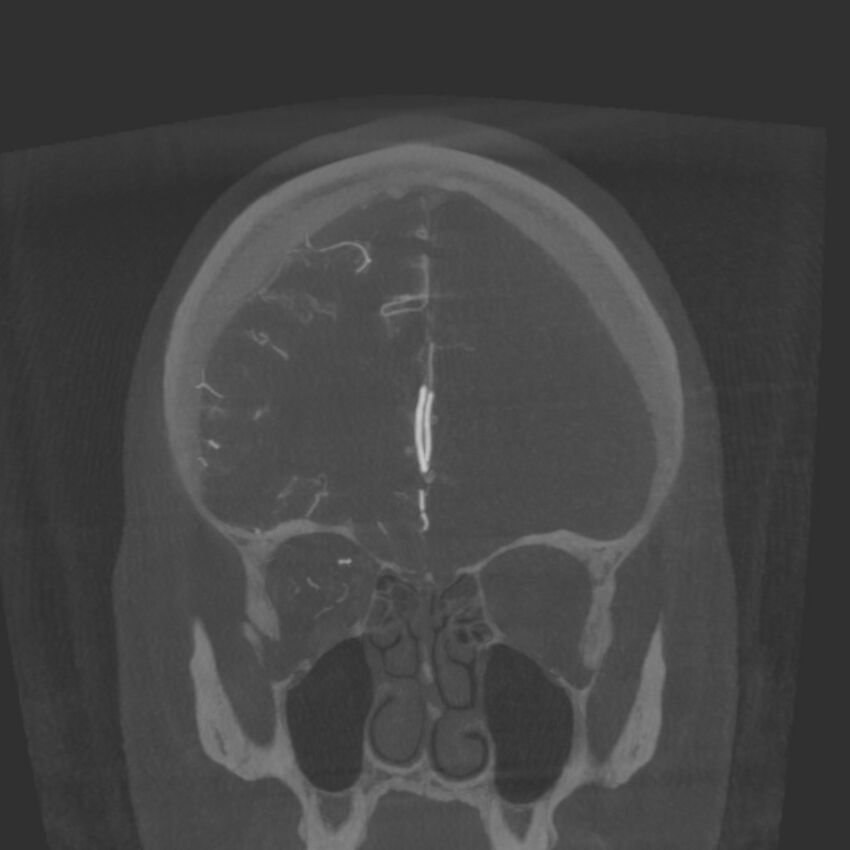 Acute subarachnoid hemorrhage and accessory anterior cerebral artery (Radiopaedia 69231-79010 Coronal arterial - MIP 25).jpg