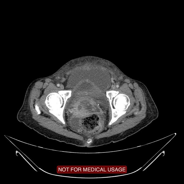File:Adenocarcinoma of the cervix (Radiopaedia 28373-28616 Axial C+ portal venous phase 23).jpg