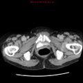 Adenocarcinoma of the colon (Radiopaedia 8191-9039 Axial renal excretory phase 62).jpg