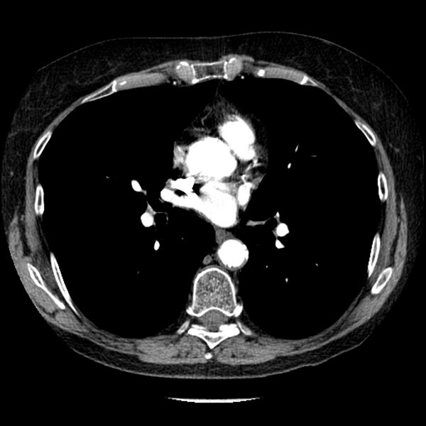 File:Adenocarcinoma of the lung (Radiopaedia 41015-43755 Axial C+ portal venous phase 65).jpg