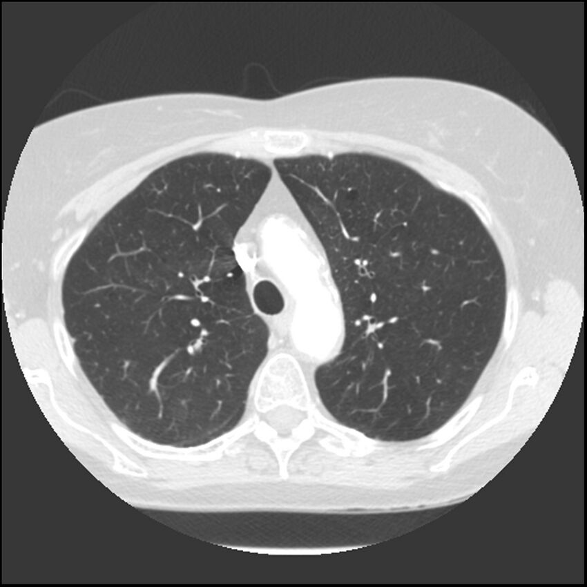 Adenocarcinoma of the lung (Radiopaedia 41015-43755 Axial lung window 36).jpg