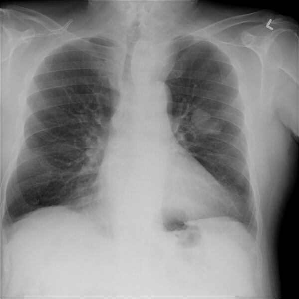 File:Adenocarcinoma of the lung (Radiopaedia 44876-48758 Frontal 1).jpg