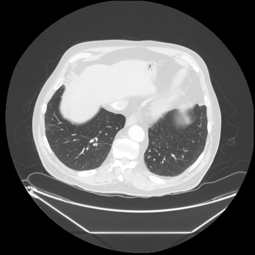Adenocarcinoma of the lung (Radiopaedia 44876-48759 Axial lung window 64).jpg