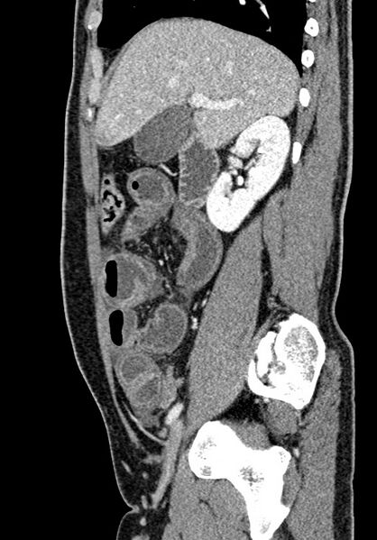 File:Adhesional small bowel obstruction (Radiopaedia 58900-66131 Sagittal C+ portal venous phase 82).jpg