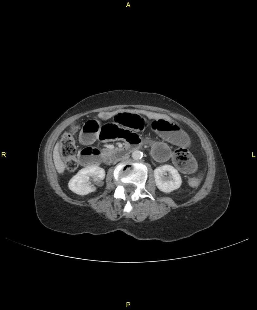 Adhesional small bowel obstruction (Radiopaedia 85402-101024 Axial C+ portal venous phase 129).jpg