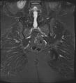 Adnexal multilocular cyst (O-RADS US 3- O-RADS MRI 3) (Radiopaedia 87426-103754 Coronal T2 fat sat 26).jpg