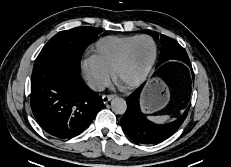 File:Adrenal metastases (Radiopaedia 73082-83791 Axial non-contrast 6).jpg
