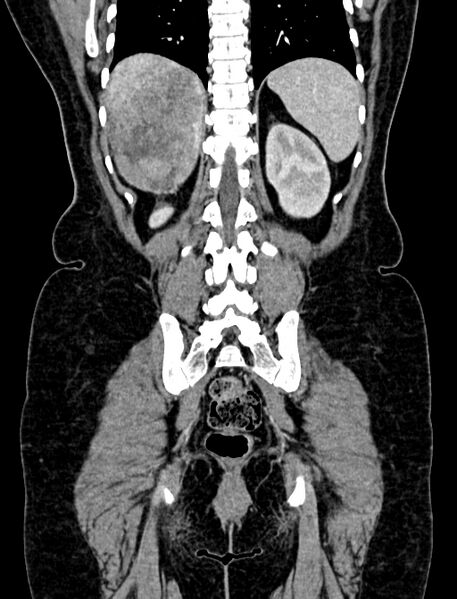 File:Adrenocortical carcinoma (Radiopaedia 87281-103569 Coronal C+ portal venous phase 109).jpg